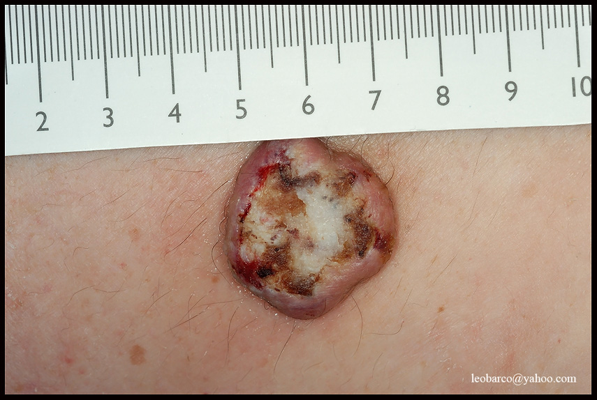 KERATOACANTHOMA_VS_SCC.jpg