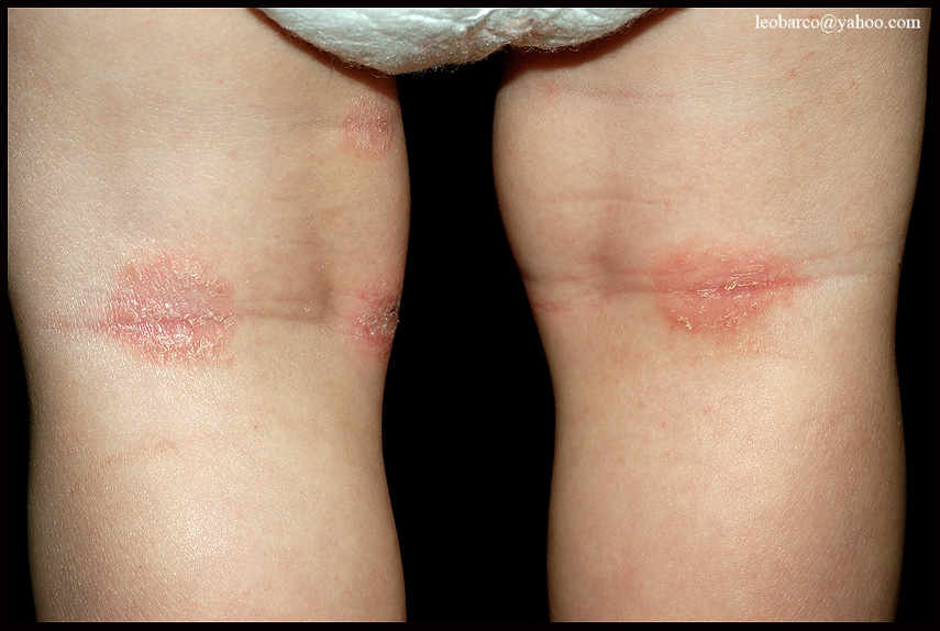 ATOPIC_DERMATITIS.jpg