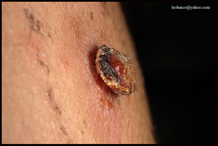 PYOGENIC GRANULOMA_02.jpg
