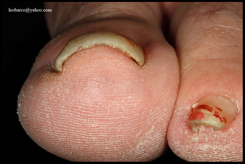 PINCER NAIL_02.JPG
