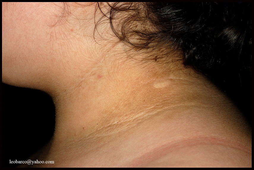 PSEUDOACANTHOSIS NIGRICANS_01.jpg