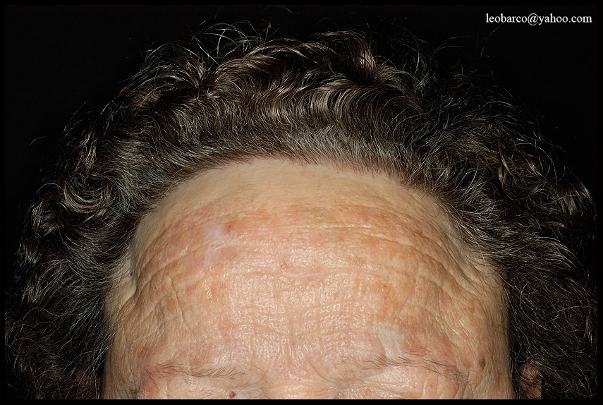 FRONTAL FIBROSING ALOPECIA.JPG
