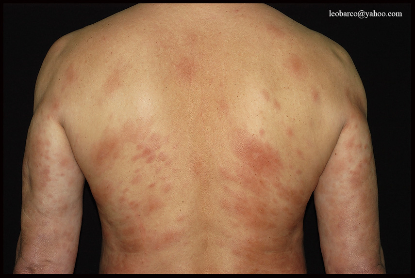 LEPROMATOUS LEPROSY_02.JPG