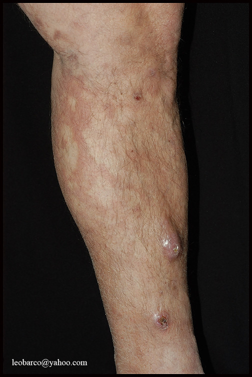 LEPROMATOUS LEPROSY_03.JPG