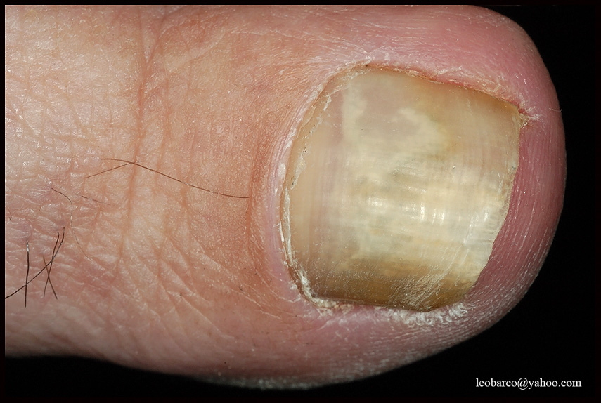 TOENAIL FUNGAL INFECTION.JPG