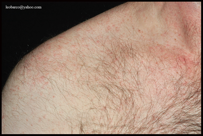 PITYROSPORUM FOLLICULITIS_01.JPG
