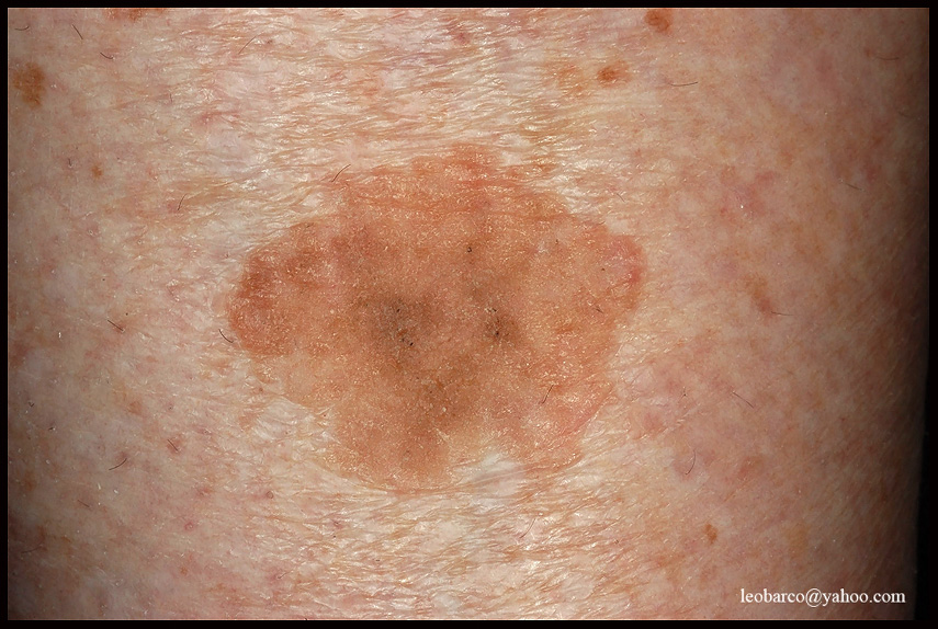 SEBORRHOEIC KERATOSIS OF THE LEG.JPG