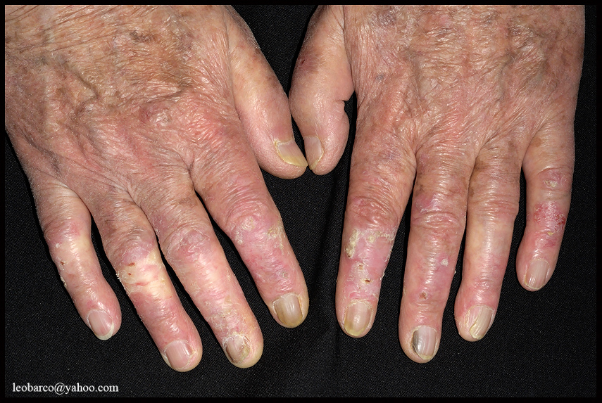 RADIATION DERMATITIS_01.jpg
