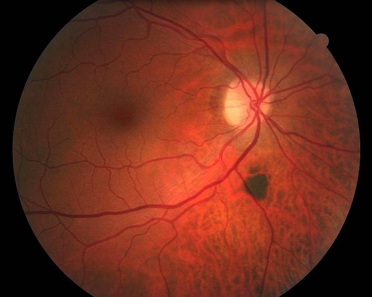Choroidal Nevus