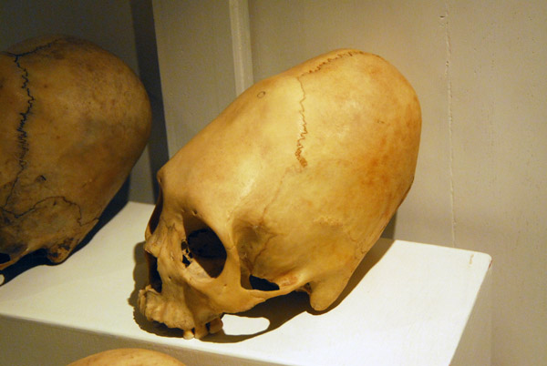 Elongated skull - artificial cranial deformation, Inca