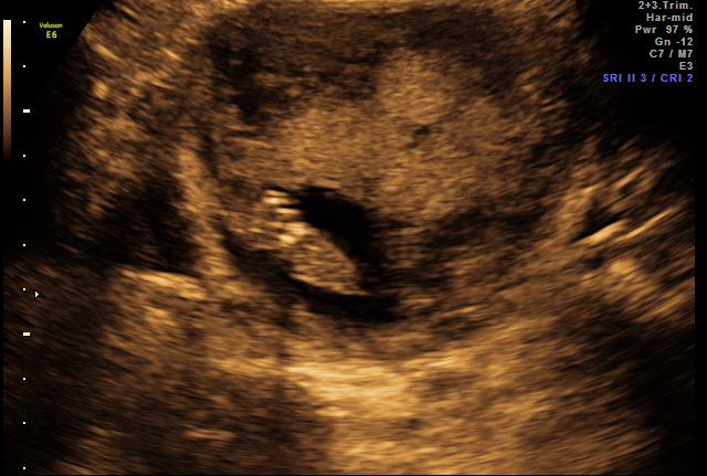 Ultrasound - Feb 19, 2010 - #3