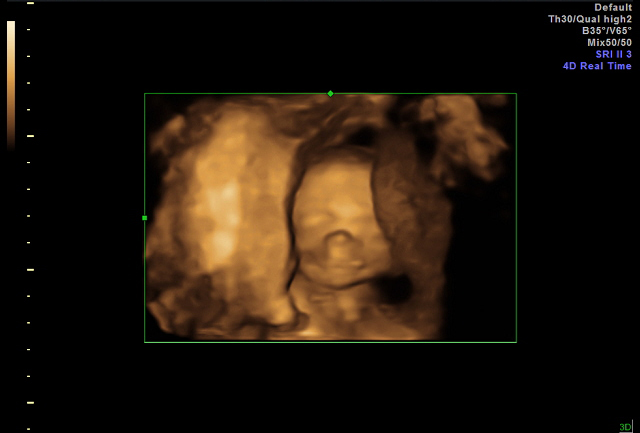 Ultrasound - Feb 19, 2010 - #5