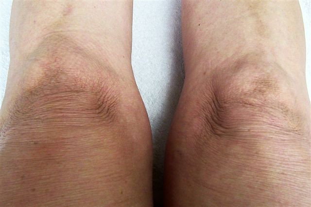 ACA rash both knees and shin discoloration close up-no. 8.jpg