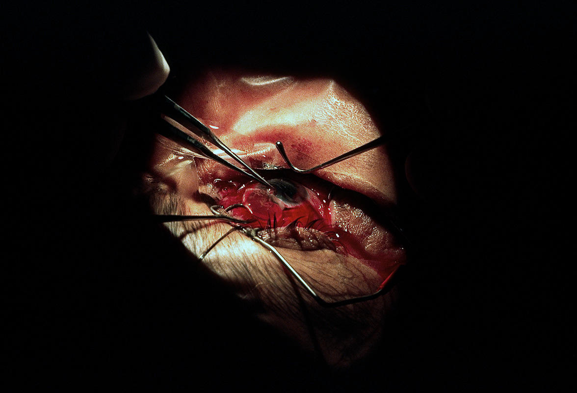 Cataract Surgery