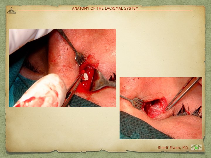 Anatomy of Lacrimal System.044.jpeg