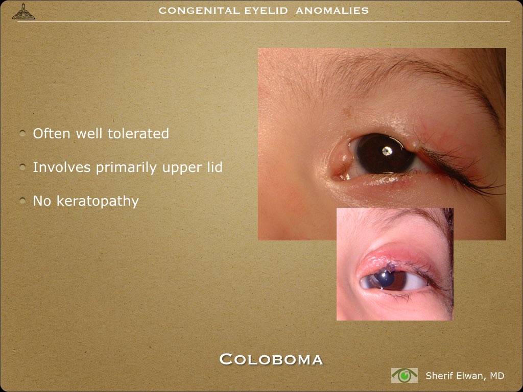 Pathology - Eyelids Cong Anom.010.jpeg