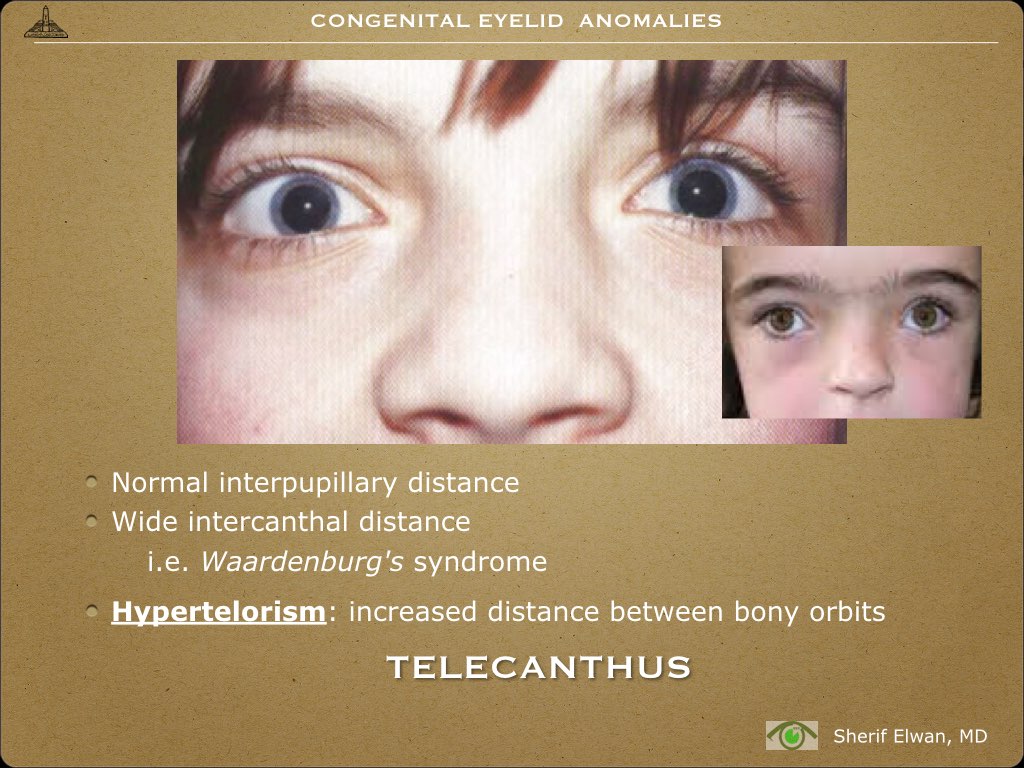 Pathology - Eyelids Cong Anom.022.jpeg