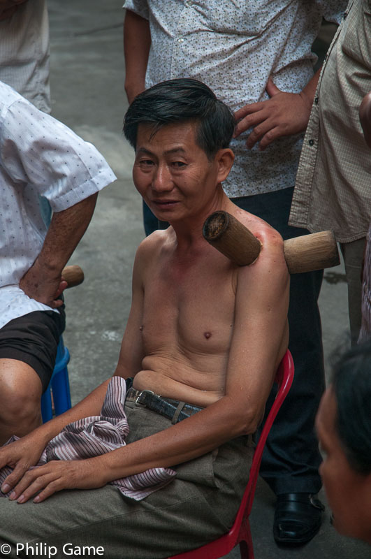 Cupping, a traditional form of healing