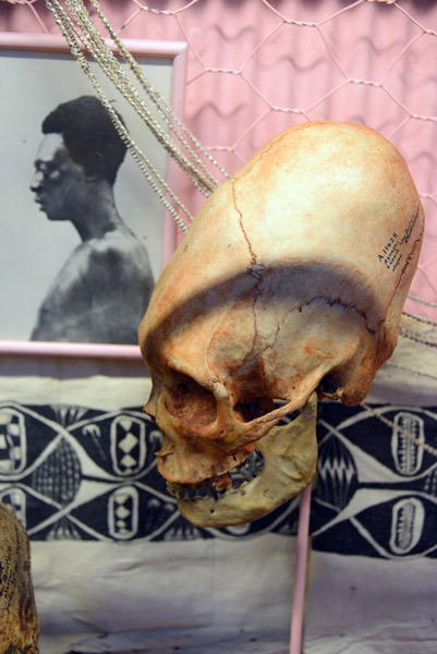 Distorted skull, Ablingi, West New Britain, PNG
