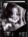 My son, Alex, as a fetus, about 6 months.