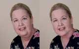 Double Chin Correction.jpg