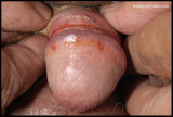 ZOONS BALANITIS.jpg