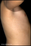 ASYMMETRIC PERIFLEXURAL EXANTHEM OF CHILHOOD_02.JPG