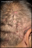 SCALP FOLLICULITIS_DISSECTING CELLULITIS OF THE SCALP_01.jpg