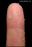 EXFOLIATIVE KERATOLYSIS_03.jpg
