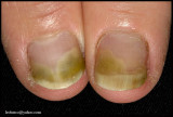 PSEUDOMONAS FINGERNAIL INFECTION.jpg