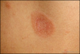 pityriasis_rosea_02_h.JPG