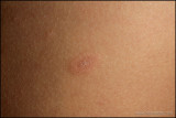 pityriasis_rosea_03_h.JPG