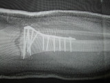 My bionic knee.  I have 3 months of no weight, another 3 months of muscle building.  Hardware can come out in 1.5 years.