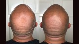 The benefits of Scalp micropigmentation on men