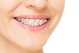 Affordable Options of Braces in Glendale