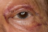 Day five  Left eye  March 11, 2024