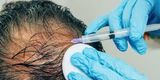 prp hair treatment in chennai