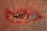 ELECTRICAL BURN / Brlure lectrique
