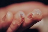 Zones cutanes brles par des arcs lectriques / Multiple burned skin spots by dancing whiplash electric arcs