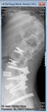XRay photo 1A day of ADR surgery.jpg