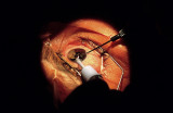 Cataract Surgery