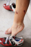 Wanda's dog bite 08_04_08.jpg