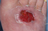 Open Wound After Surgery