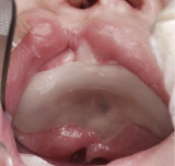 One example of Nasal Alveolar Molding