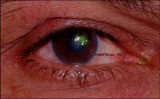 2.Corneal Ulcer