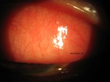 25.Conjunctival Follicles