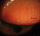 26.Conjunctival Papillae