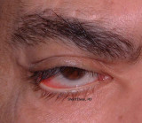 37.Lower Lid Paralytic Ectropion: VIIth-nerve Palsy