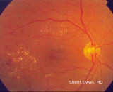 56.Pre-proliferative Diabetic Retinopathy: Soft Exudates