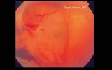 57.Pre-proliferative Diabetic Retinopathy: Pre-retinal Haemorrhage